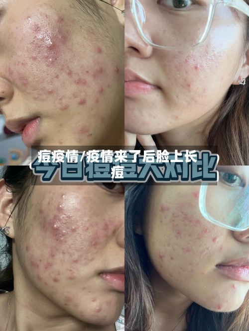 痘疫情/疫情来了后脸上长痘