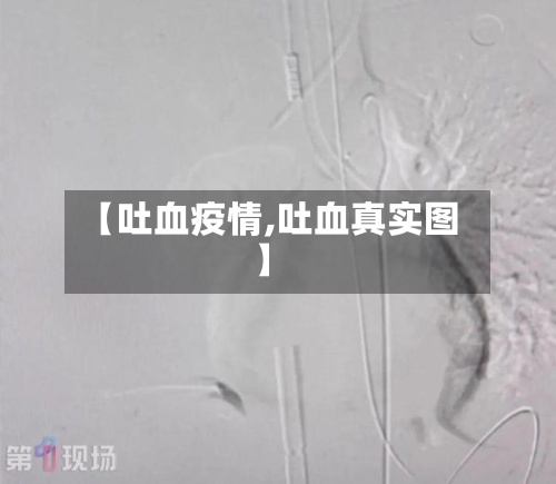 【吐血疫情,吐血真实图】