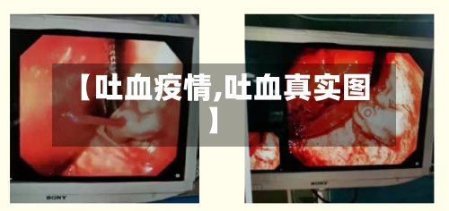 【吐血疫情,吐血真实图】-第2张图片